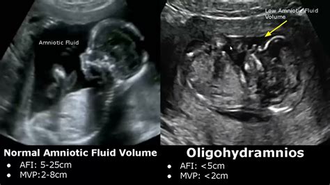 Amniotic Fluid Volume Ultrasound Normal Vs Abnormal | Oligohydramnios/Polyhydramnios | AFP/MVP ...