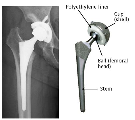 Long-life artificial hip joint reaches the bedside | UTokyo Research