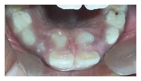 Intraoral photograph showing palatally erupted paired tuberculate ...