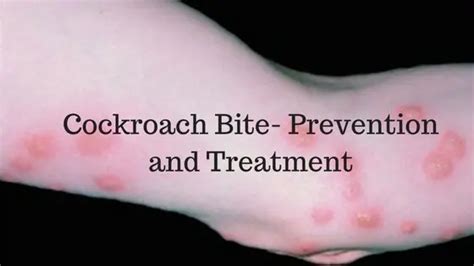 Cockroach bite symptoms Archives - Mobility Physiotherapy Clinic