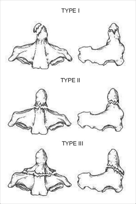 Odontoid Fracture Types