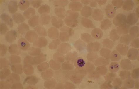 File:Plasmodium falciparum 02.jpg - Wikimedia Commons