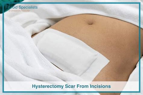 Hysterectomy Scar From Incisions with Pictures | Fibroid Specialists