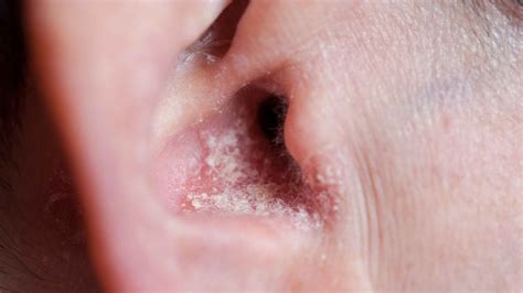 Psoriasis In The Ear: Symptoms, Treatment, and Prevention – Dermeleve®