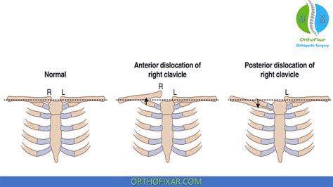 Sternoclavicular Joint Dislocation | OrthoFixar 2024