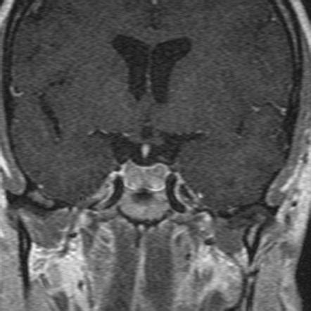 Pituitary haemorrhage | Radiology Case | Radiopaedia.org