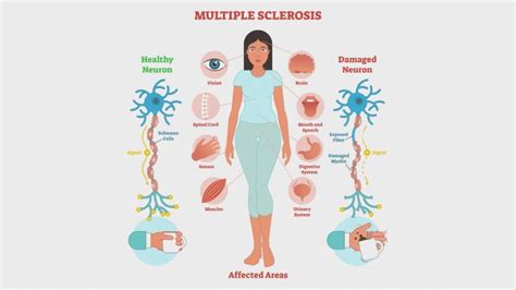 Multiple Sclerosis - Symptoms & 4 Ultimate Causes