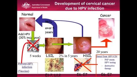 Cervical Cancer Screening. Is this the end of the pap smear? - YouTube