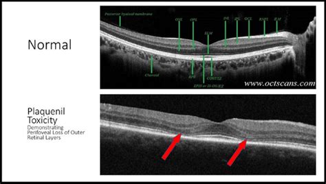 Thursday Clinical Pearls - Plaquenil Toxicity - VISIONAMERICA DOCTORS