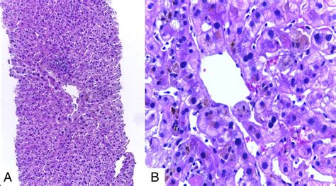 Icteric Variant of Stauffer Syndrome as a Paraneoplastic Man... : ACG Case Reports Journal