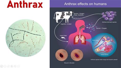 Anthrax: Symptoms, Diagnosis, Treatment & Prevention | Bacillus anthracis - YouTube