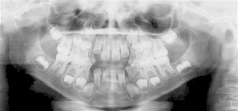 Initial panoramic radiograph | Download Scientific Diagram