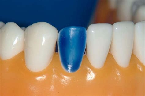 Mandibular Right Lateral Incisor (4.2 FDI, 26 Universal) - Labial and Incisal Veneer Preparation