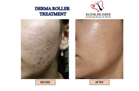 Derma Roller Treatment - Anti Aging - Aesthetic Clinic Malaysia