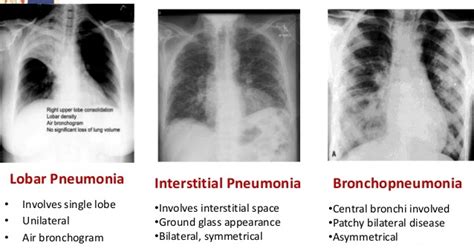 Pneumonia clinical Aspect and Rational Treatment ~ Pharmacy Portal