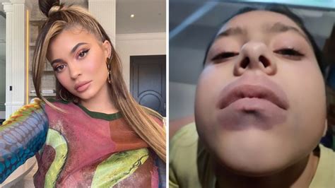 Kylie Jenner Lip Challenge leads to girl’s shock diagnosis | 7NEWS