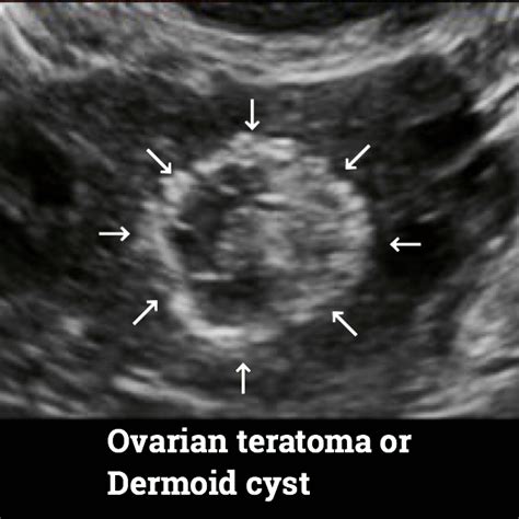 Teratoma. Causes, symptoms, diagnosis and treatment. - Ultrasoundfeminsider