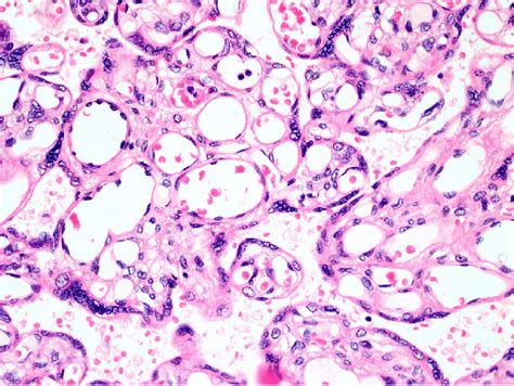 Representative sample of chorangiosis. Mature chorionic villi showing... | Download Scientific ...