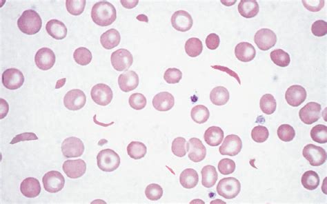 Sickle Cell Anemia