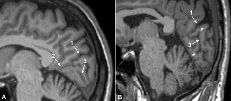 Sagittal MRI showing. a Discontinuous character of the calcarine ...