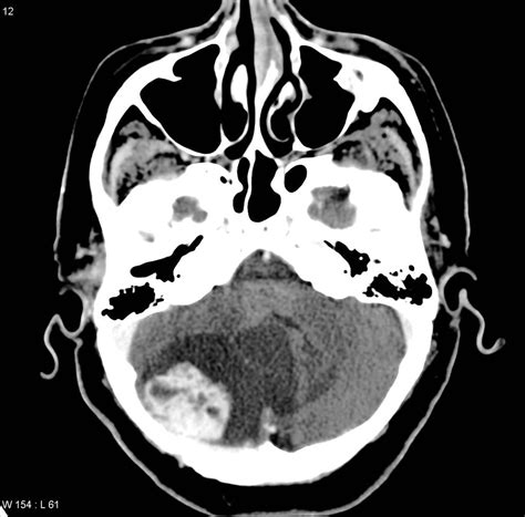 Von Hippel-Lindau Disease - USMLE Strike