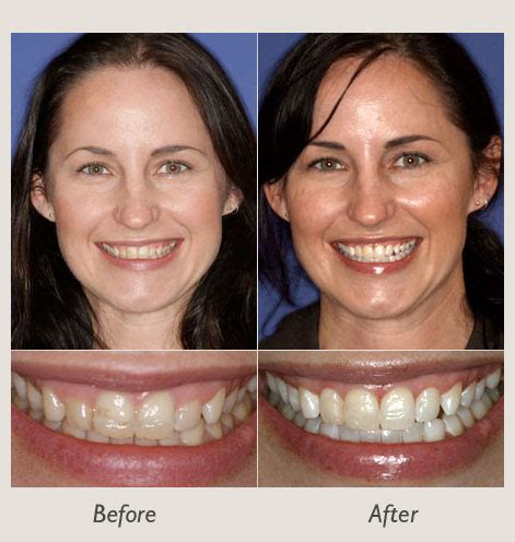 Cosmetic Gum Lifts | Dallas TX | Dallas Dental Arts