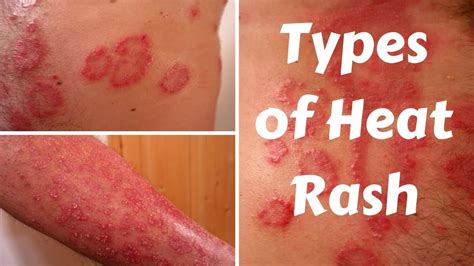 Types of Heat Rash - YouTube