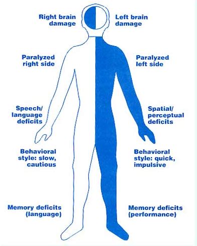 Flaccid Hemiplegia – Telegraph