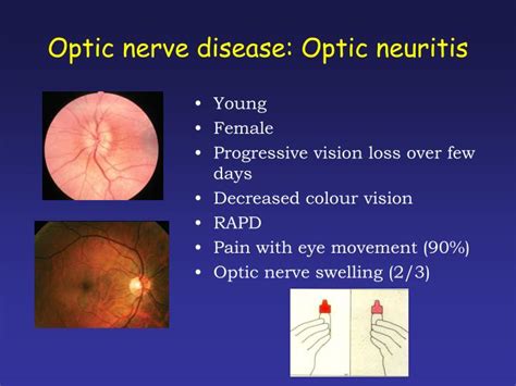 PPT - Back to Basics Ophthalmology: Acute visual disturbance/loss PowerPoint Presentation - ID ...