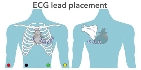 ECG placement & mis-LEADing ECG’s – EMbeds.co.uk