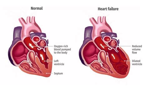 Unhealthy Heart Diagram