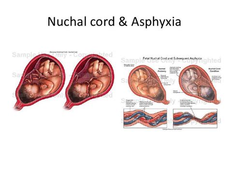 Dilemmas In The Management Of Nuchal Cord