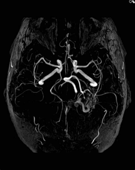 What Is Arteriovenous Malformation Types Symptoms Tre - vrogue.co