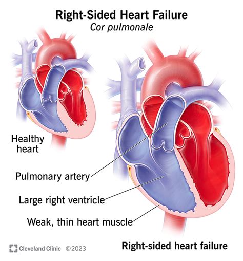 Cor Pulmonale: Symptoms and Causes