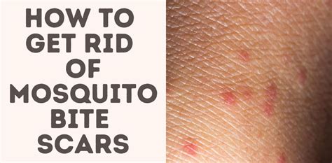 How To Get Rid Of Mosquito Bite Scars - Treat Your Scars