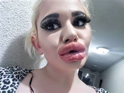 A Bulgarian Girl Had 17 Lip Augmentation Surgeries and Wants More! - DemotiX