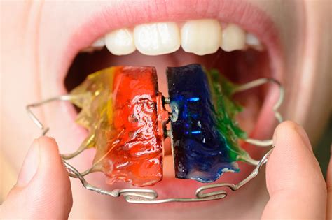 Treatments: All About Braces, Plates and Aligners - Orthodontics New Zealand