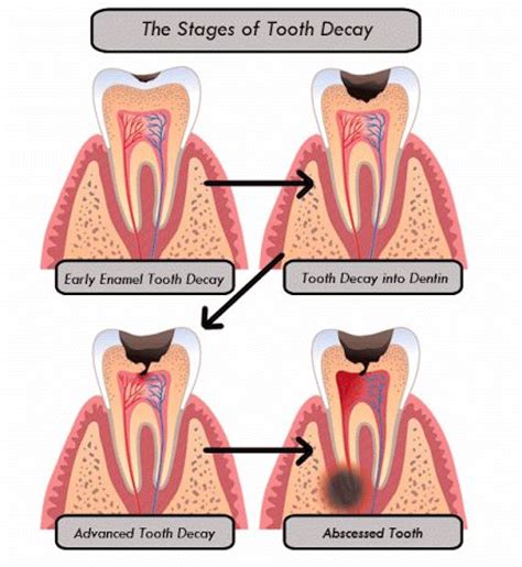 The Stages of Tooth Decay: 1. Early Enamel Tooth Decay. 2. Tooth Decay into Dentin. 3. Advanced ...