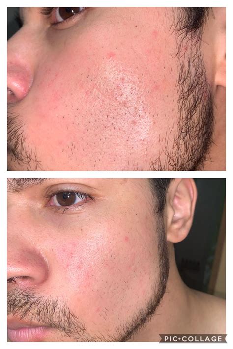 Hello is this a damaged moisture barrier or seb derm ? : r/SkincareAddicts