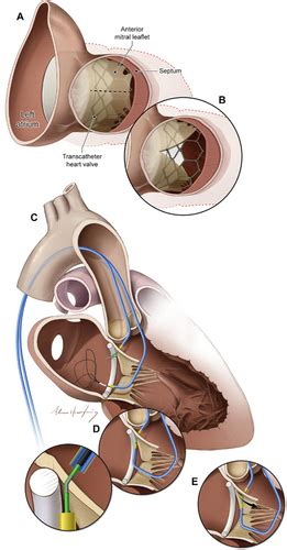 Intentional Percutaneous Laceration of the Anterior Mitral Leaflet to ...