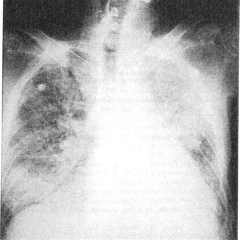 Figu re 5. The echocardiogram revealed a picture of global hypokinesia... | Download Scientific ...