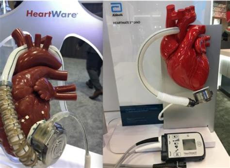 What Happens If LVAD Battery Dies? | Battery Tools