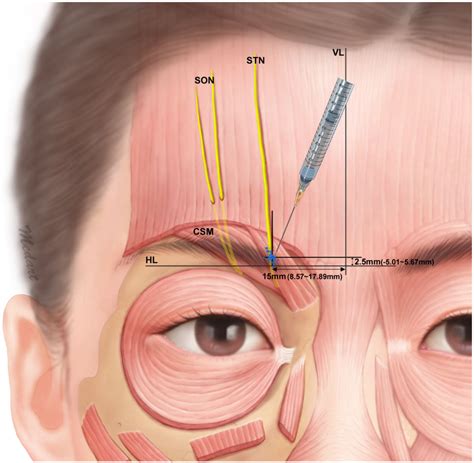 corrugator supercilii - Google 검색 | Human anatomy, Anatomy reference, Anatomy