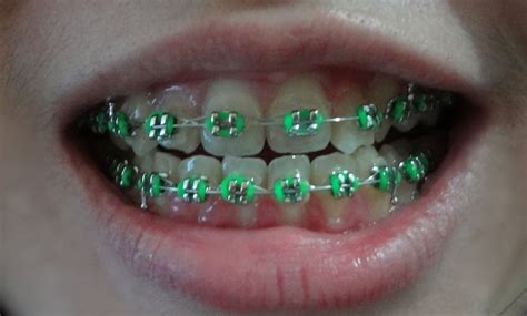 is green a good color for braces - By A Great Webcast Frame Store