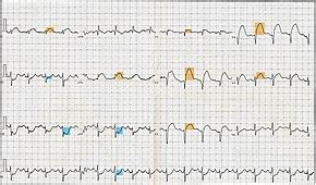 Electrocardiography in myocardial infarction - Wikipedia