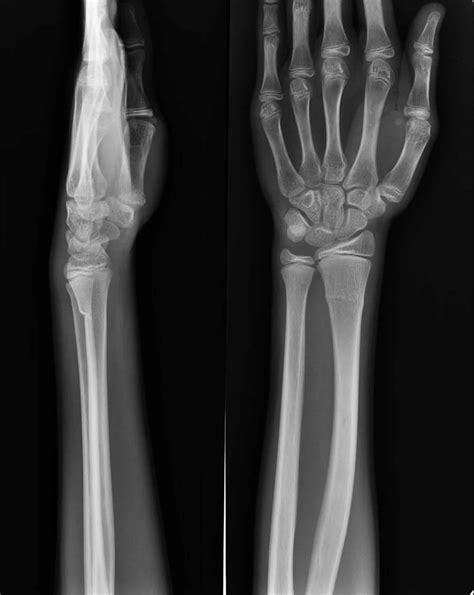 Torus fracture definition, causes, diagnosis & torus fracture treatment