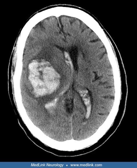 Basal ganglia hemorrhage | MedLink Neurology