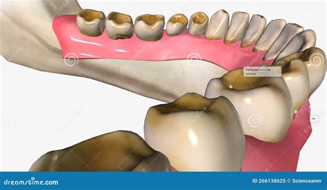 Dental Erosion, Also Known As Tooth Erosion Stock Illustration ...