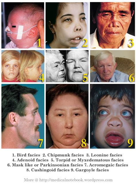 Facies in different medical conditions | Exposiciones, Medicos