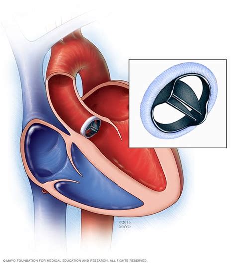 Bicuspid aortic valve - Overview - Mayo Clinic | Heart valves, Aortic valve replacement, Heart ...